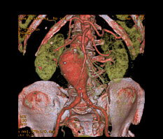 画像症例：腹部大動脈瘤